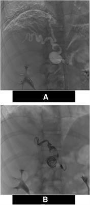 Case report: Complex arterial findings in vascular ehlers-danlos syndrome with a novel COL3A1 variant and death at young age